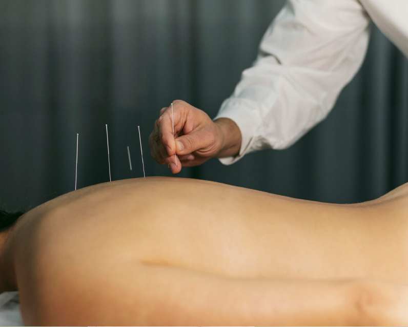 dry needling nj