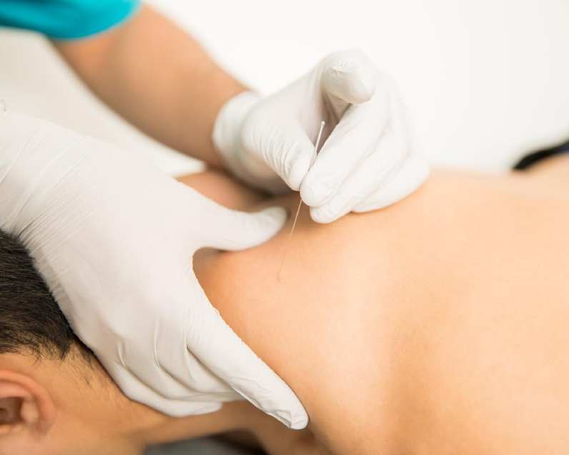 dry needling nj